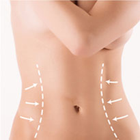 Abdominoplastie