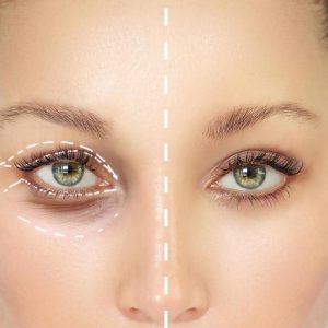 blefaroplastie-113